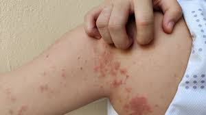 Casos de lepra en Salta: confirman nuevos diagnósticos y refuerzan la prevención